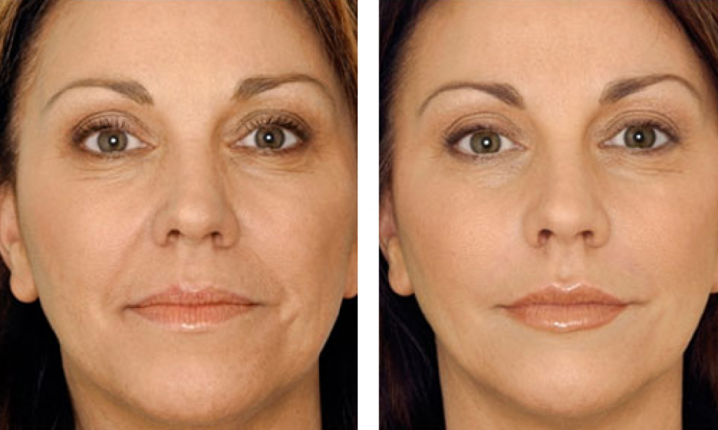 Dermal and lip fillers in Guildford First Aesthetics